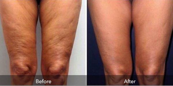 Thigh Contouring